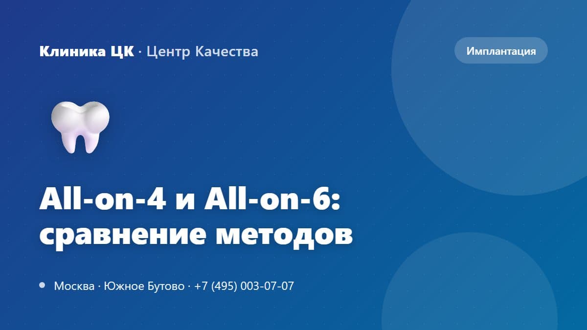All-on-4 и All-on-6: сравнение методов протезирования на имплантатах